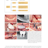 Horizontal and Vertical Bone Augmentation for Dental Implant Therapy