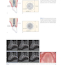 Horizontal and Vertical Bone Augmentation for Dental Implant Therapy