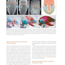 Horizontal and Vertical Bone Augmentation for Dental Implant Therapy