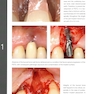 Mucogingival Esthetic Surgery Around Implants 1st Edition