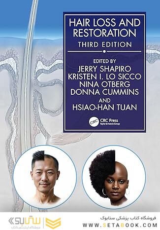Hair Loss and Restoration 3rd Edition
