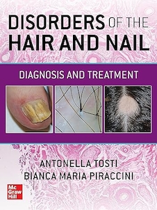 عکس Disorders of the Hair and Nail: Diagnosis and Treatment 1st Edition