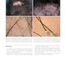 Atlas of Trichoscopy: Dermoscopy in Hair and Scalp Disease