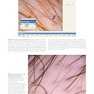 Atlas of Trichoscopy: Dermoscopy in Hair and Scalp Disease