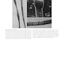 Atlas of Trichoscopy: Dermoscopy in Hair and Scalp Disease