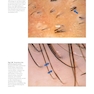Atlas of Trichoscopy: Dermoscopy in Hair and Scalp Disease