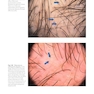 Atlas of Trichoscopy: Dermoscopy in Hair and Scalp Disease