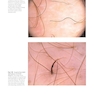 Atlas of Trichoscopy: Dermoscopy in Hair and Scalp Disease