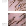 Atlas of Trichoscopy: Dermoscopy in Hair and Scalp Disease