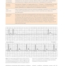 Cardiac Pacing and ICDs
