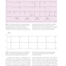 Cardiac Pacing and ICDs