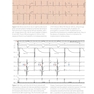 Cardiac Pacing and ICDs