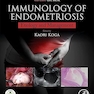 Immunology of Endometriosis: Pathogenesis and Management (Reproductive Immunology)