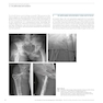 AO Principles of Fracture Management: Vol. 1: Principles, Vol. 2: Specific fractures 3rd Edition