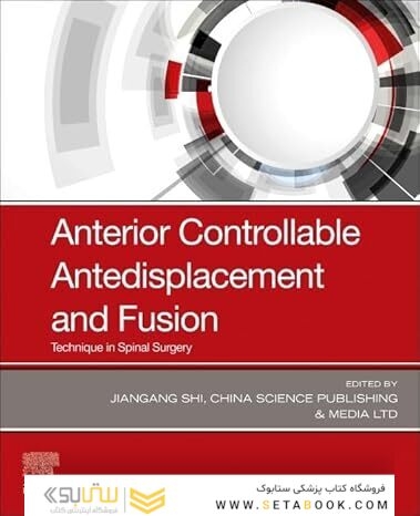 Anterior Controllable Antedisplacement and Fusion: Technique in Spinal Surgery 1st Edition