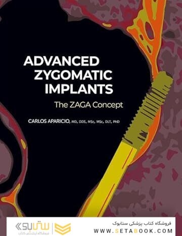 Advanced Zygomatic Implants: The Zaga Concept 1st Edition