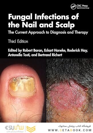 Fungal Infections of the Nail and Scalp: The Current Approach to Diagnosis and Therapy 3rd Edition