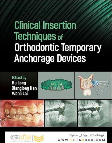 Clinical Insertion Techniques of Orthodontic Temporary Anchorage Devices 1st Edition