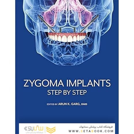 Zygoma Implants: Step by Step 1st Edition