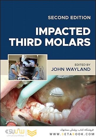 Impacted Third Molars 2nd Edition