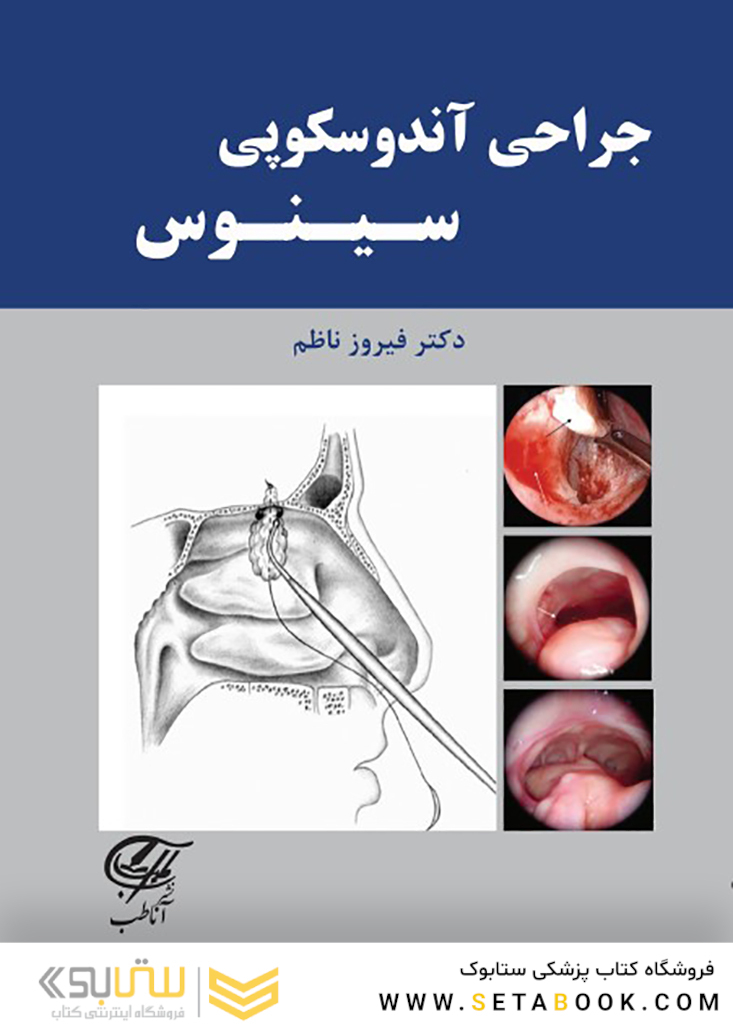 جراحی آندوسکوپی سینوس