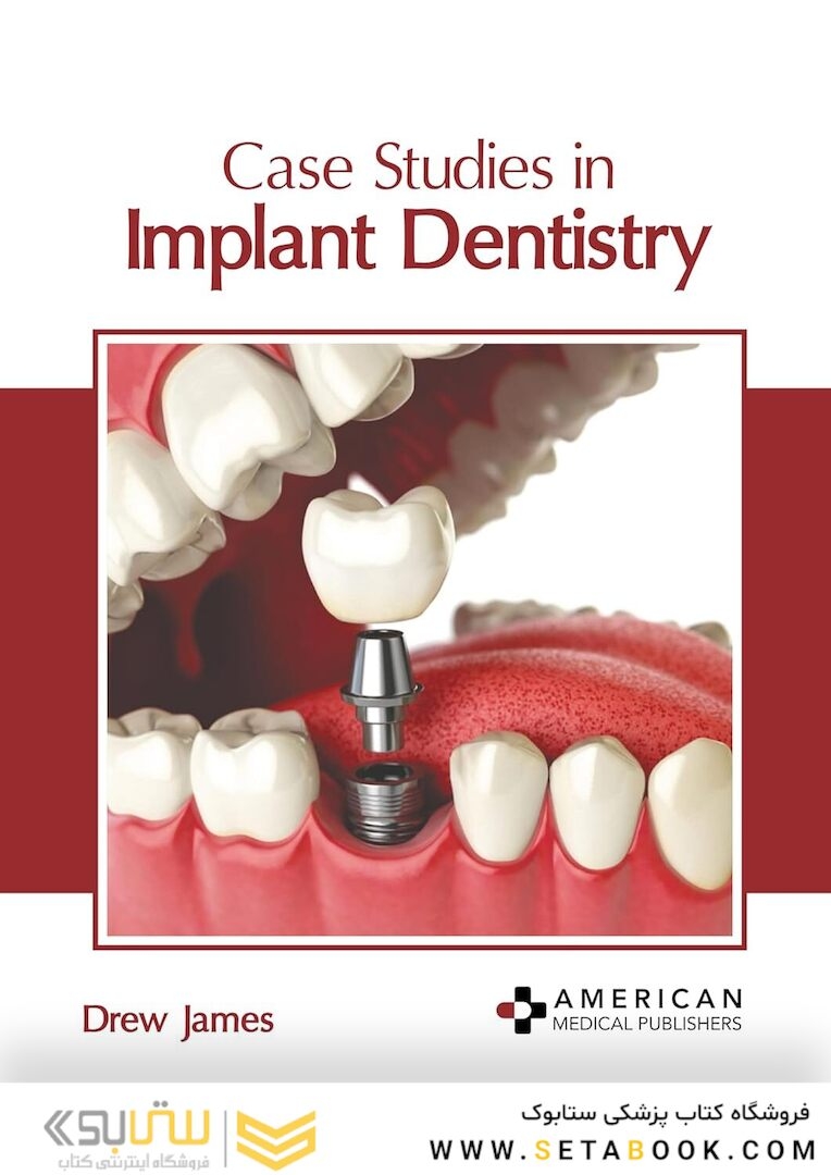 Case Studies in Implant Dentistry