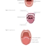 Peri-Implant Soft Tissue Management: A Clinical Guide