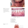 Peri-Implant Soft Tissue Management: A Clinical Guide