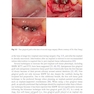 Peri-Implant Soft Tissue Management: A Clinical Guide