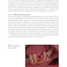 Peri-Implant Soft Tissue Management: A Clinical Guide
