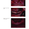 Peri-Implant Soft Tissue Management: A Clinical Guide