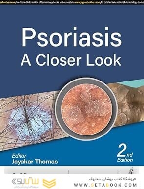 Psoriasis: A Closer Look
