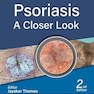 Psoriasis: A Closer Look