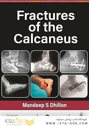Fractures of the Calcaneus