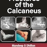 Fractures of the Calcaneus