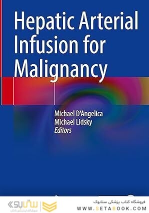 Hepatic Arterial Infusion for Malignancy