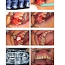 Immediate Dental Implants for Esthetic and Premolar Sites 1st Edition