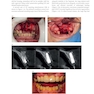 Immediate Dental Implants for Esthetic and Premolar Sites 1st Edition