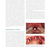 Immediate Dental Implants for Esthetic and Premolar Sites 1st Edition