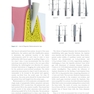 Immediate Dental Implants for Esthetic and Premolar Sites 1st Edition