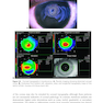2025-2026 Basic and Clinical Science Course, Section 13: Refractive Surgery