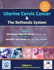 عکس Uterine Cervix Cancer The Bethesda System