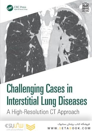 Challenging Cases in Interstitial Lung Diseases: A High-resolution Ct Approach