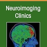 Management and Treatment of Cerebral Aneurysms
