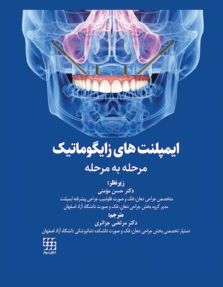عکس ایمپلنت های زایگوماتیک - مرحله به مرحله