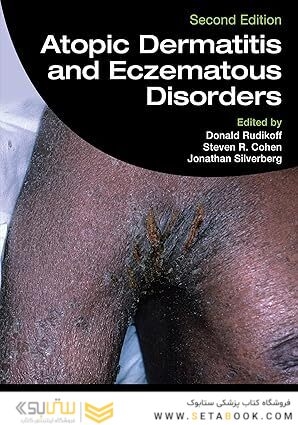 Atopic Dermatitis and Eczematous Disorders