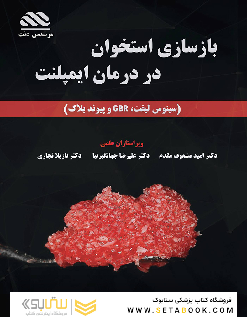 بازسازی استخوان در درمان ایمپلنت