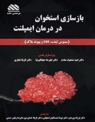 عکس بازسازی استخوان در درمان ایمپلنت