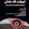 ایمپلنت تک دندان