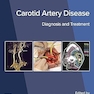 Carotid Artery Disease: Diagnosis and Treatment
